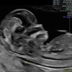 Diagnóstico prenatal