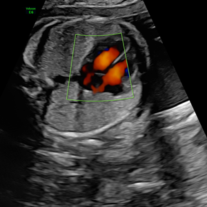 Ecocardiografía fetal